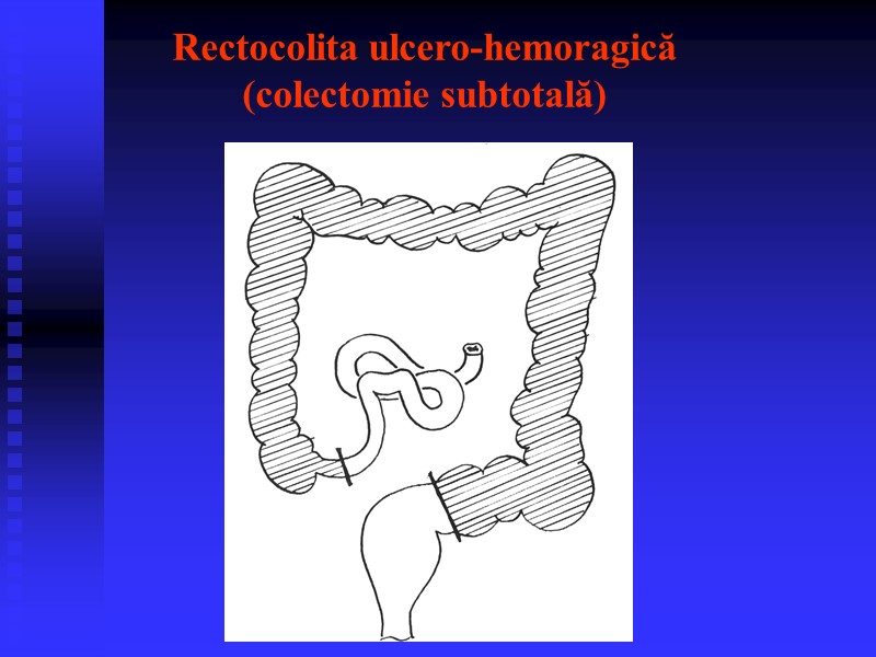 Rectocolita ulcero-hemoragică (colectomie subtotală)